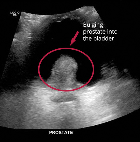 Specialist Urologist Doctor Sydney: Dr. David Ende -Bulging prostate into the bladder