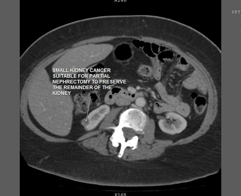 Small Kidney Cancer