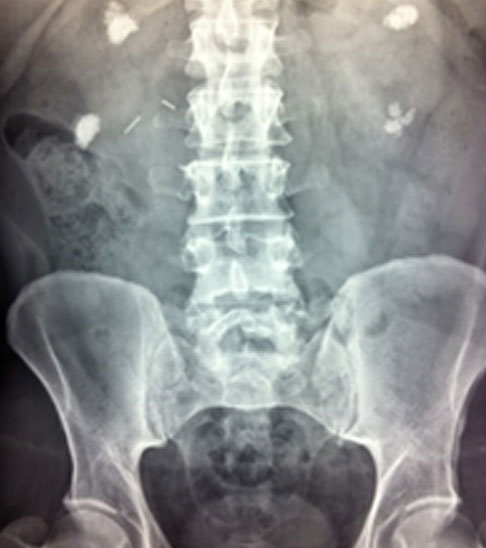 Plain Xray showing large calcified stones