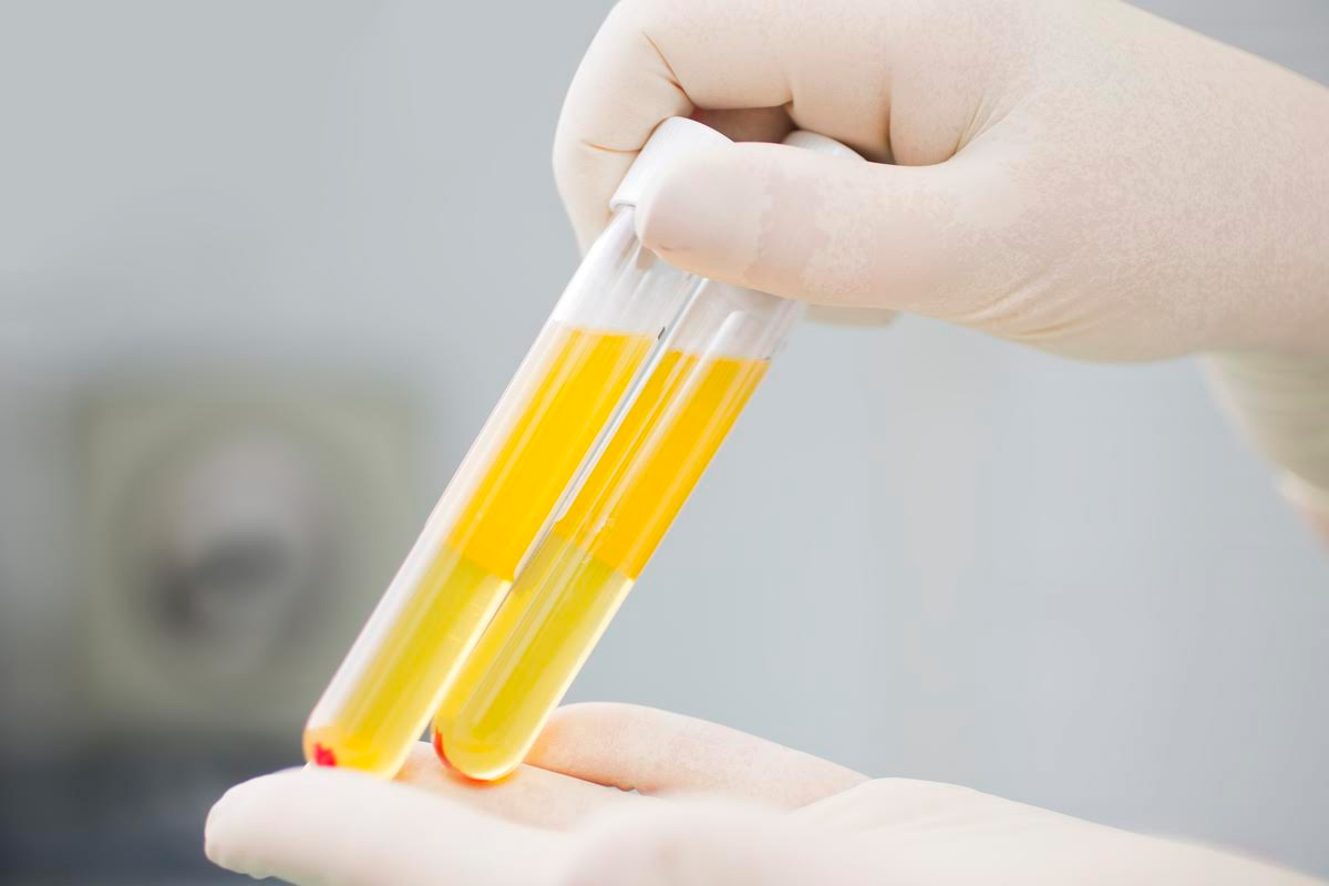 Is Blood in My Urine Serious Endeurology